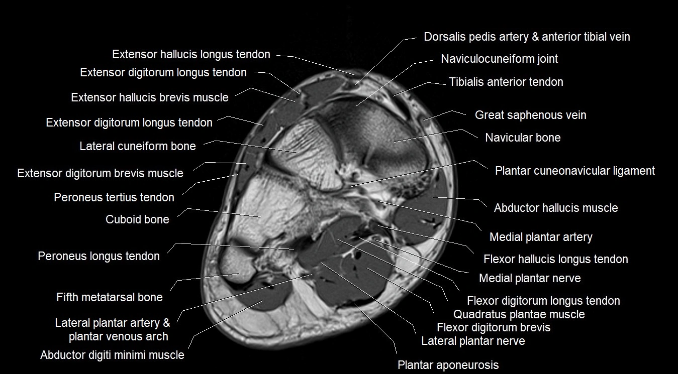 MRI 3T foot axial cross sectional anatomy image 7.webp